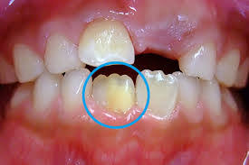 子供の歯の変色は、虫歯？